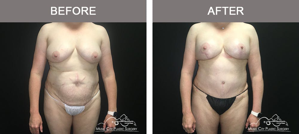 Tummy Tuck (Abdominoplasty) Before & After Gallery - Patient 842392 - Image 1