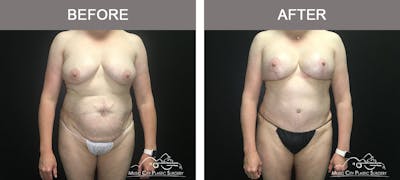 Tummy Tuck (Abdominoplasty) Before & After Gallery - Patient 842392 - Image 1