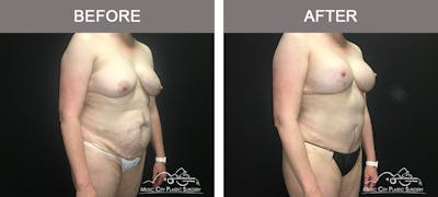 Tummy Tuck (Abdominoplasty) Before & After Gallery - Patient 842392 - Image 2