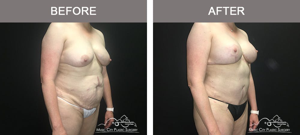 Tummy Tuck (Abdominoplasty) Before & After Gallery - Patient 842392 - Image 2