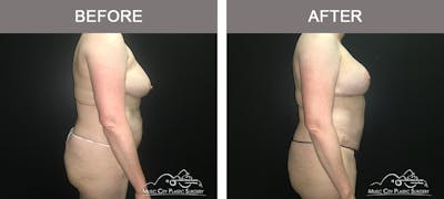 Tummy Tuck (Abdominoplasty) Before & After Gallery - Patient 842392 - Image 3