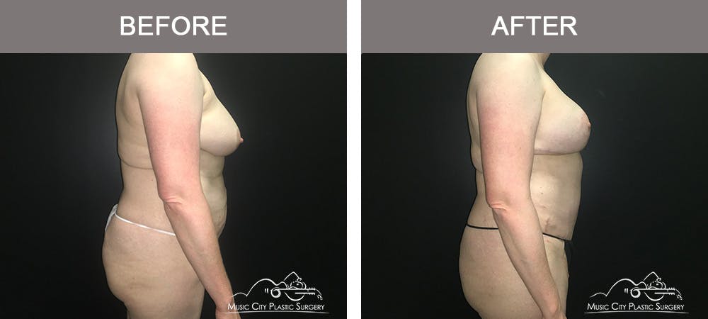 Tummy Tuck (Abdominoplasty) Before & After Gallery - Patient 842392 - Image 3