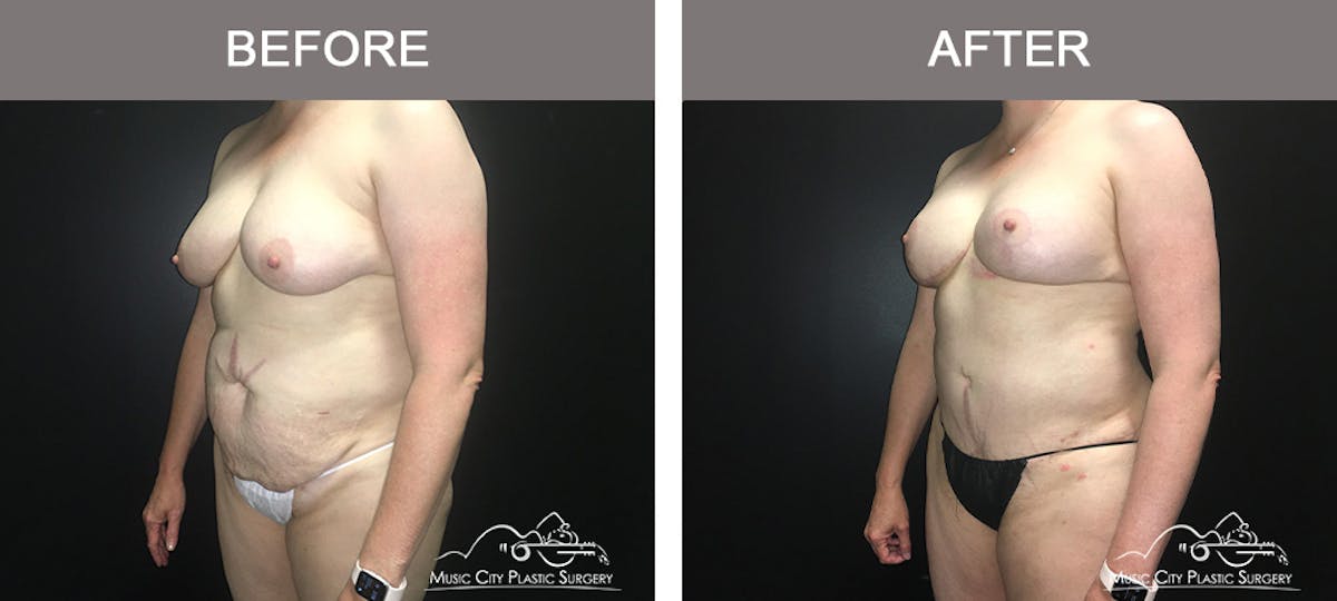 Tummy Tuck (Abdominoplasty) Before & After Gallery - Patient 842392 - Image 4