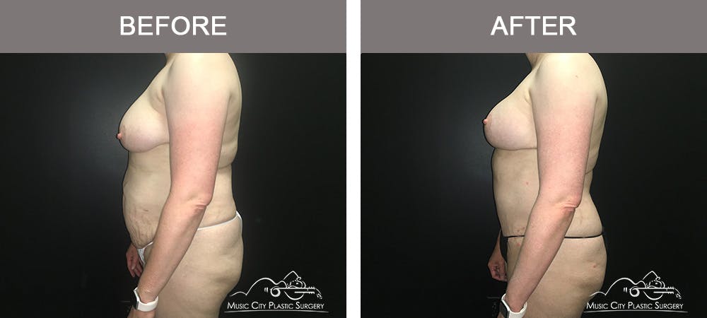 Tummy Tuck (Abdominoplasty) Before & After Gallery - Patient 842392 - Image 5