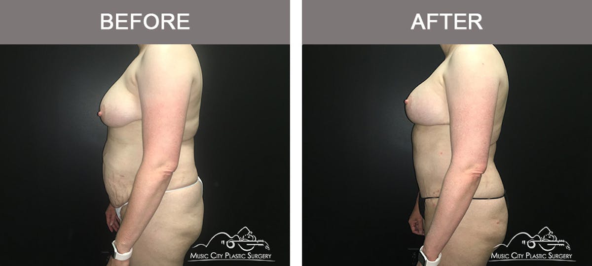 Tummy Tuck (Abdominoplasty) Before & After Gallery - Patient 842392 - Image 5