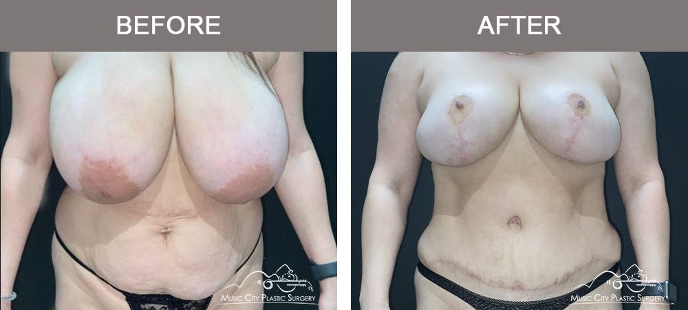 Breast Lift Before & After Gallery - Patient 602666 - Image 1