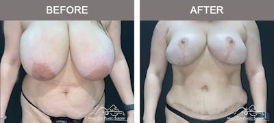 Breast Lift Before & After Gallery - Patient 602666 - Image 1