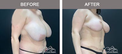 Mommy Makeover Before & After Gallery - Patient 517344 - Image 2