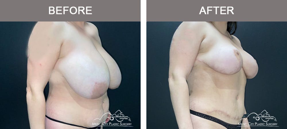 Breast Lift Before & After Gallery - Patient 602666 - Image 2