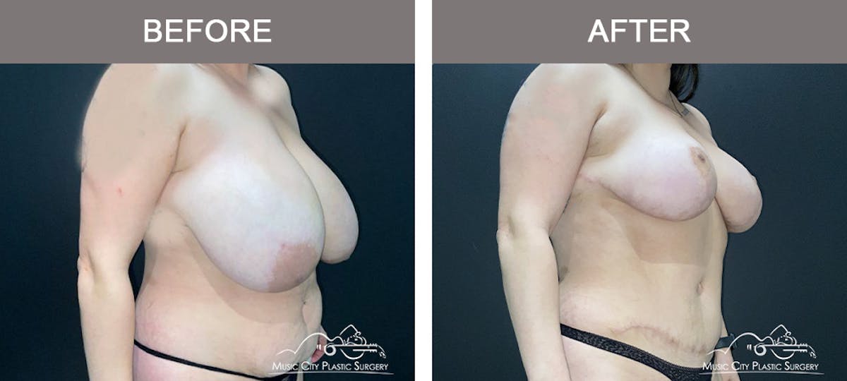 Breast Lift Before & After Gallery - Patient 602666 - Image 2