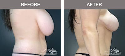 Mommy Makeover Before & After Gallery - Patient 517344 - Image 3