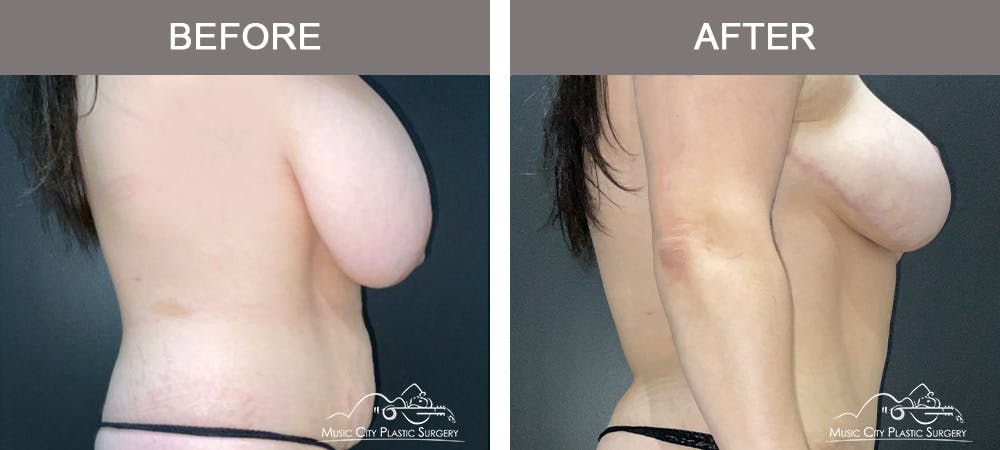 Breast Lift Before & After Gallery - Patient 602666 - Image 3