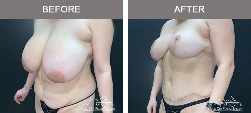 Breast Lift Before & After Gallery - Patient 602666 - Image 4