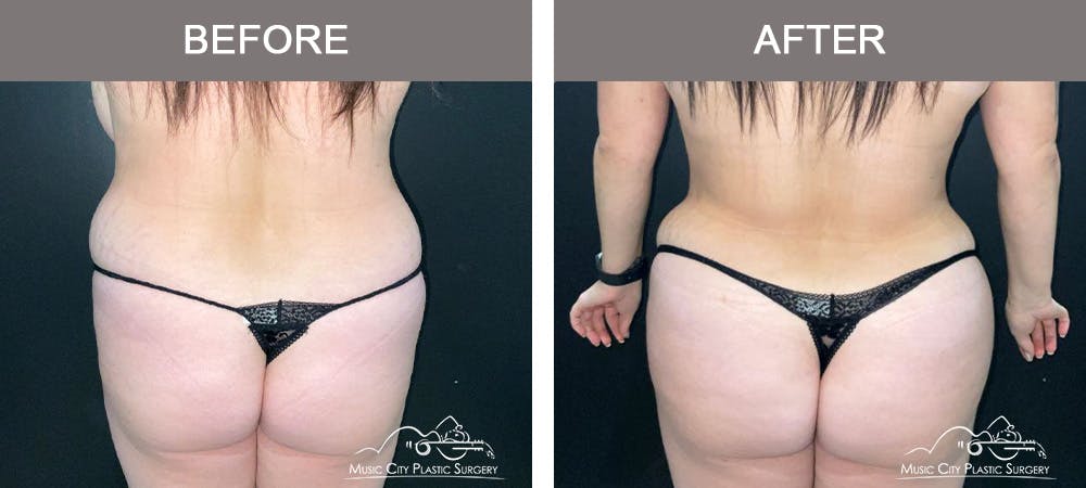 Breast Lift Before & After Gallery - Patient 602666 - Image 6