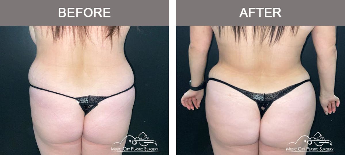 Breast Lift Before & After Gallery - Patient 602666 - Image 6