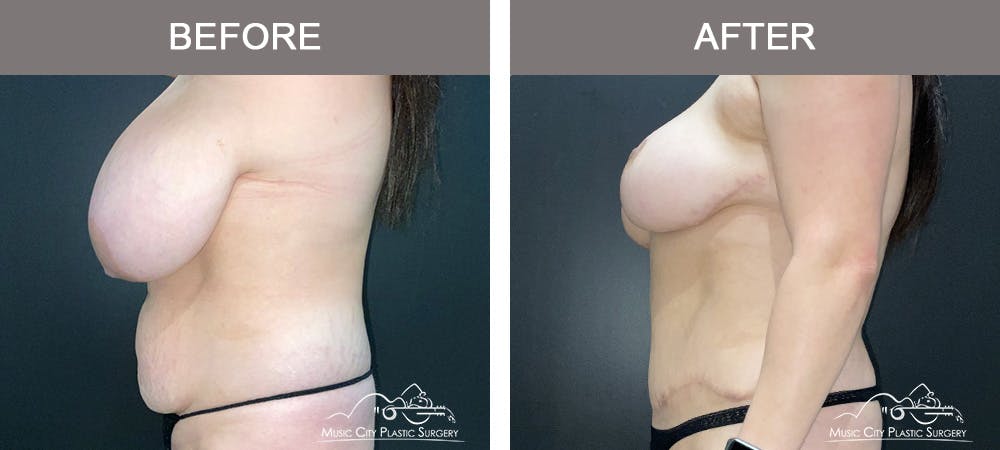 Breast Lift Before & After Gallery - Patient 602666 - Image 5