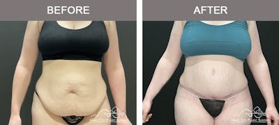 Tummy Tuck (Abdominoplasty) Before & After Gallery - Patient 281638 - Image 1