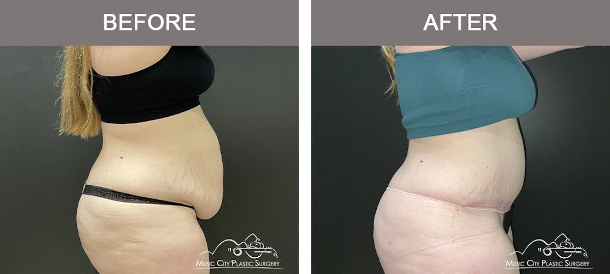 Tummy Tuck (Abdominoplasty) Before & After Gallery - Patient 281638 - Image 2