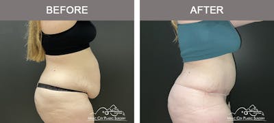 Liposuction Before & After Gallery - Patient 159234 - Image 2