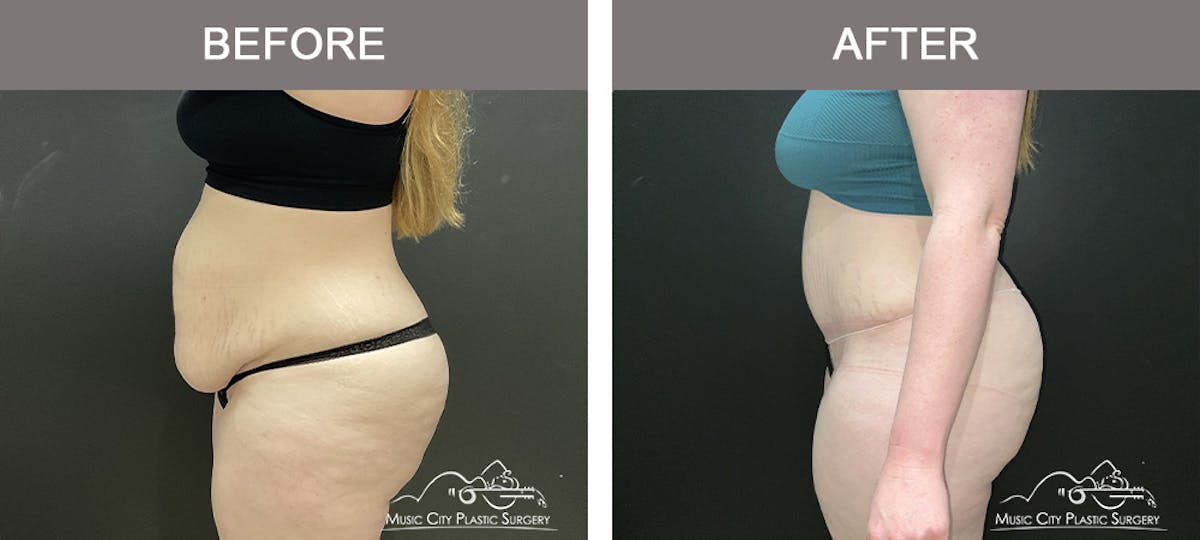 Tummy Tuck (Abdominoplasty) Before & After Gallery - Patient 281638 - Image 3