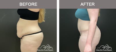 Liposuction Before & After Gallery - Patient 159234 - Image 3