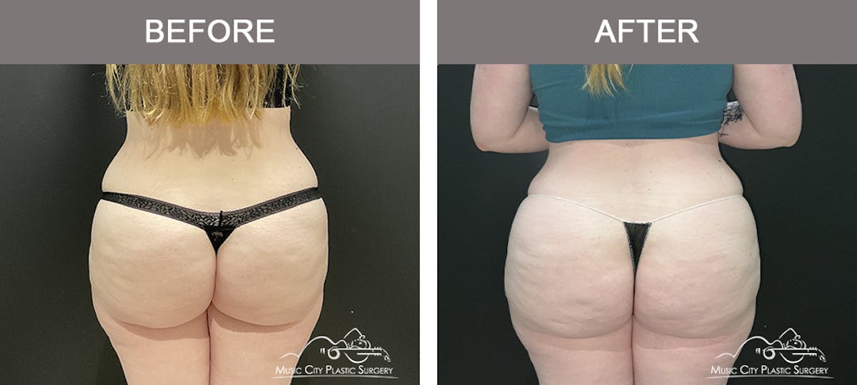 Tummy Tuck (Abdominoplasty) Before & After Gallery - Patient 281638 - Image 4