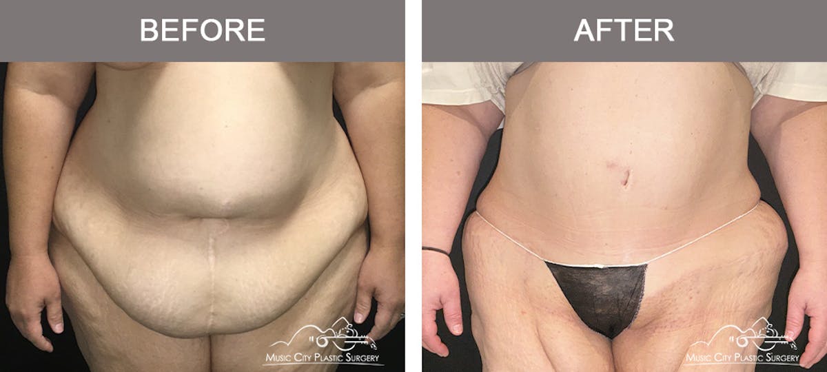Tummy Tuck (Abdominoplasty) Before & After Gallery - Patient 211968 - Image 1