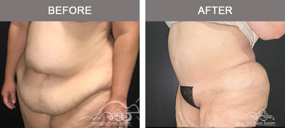 Tummy Tuck (Abdominoplasty) Before & After Gallery - Patient 211968 - Image 2