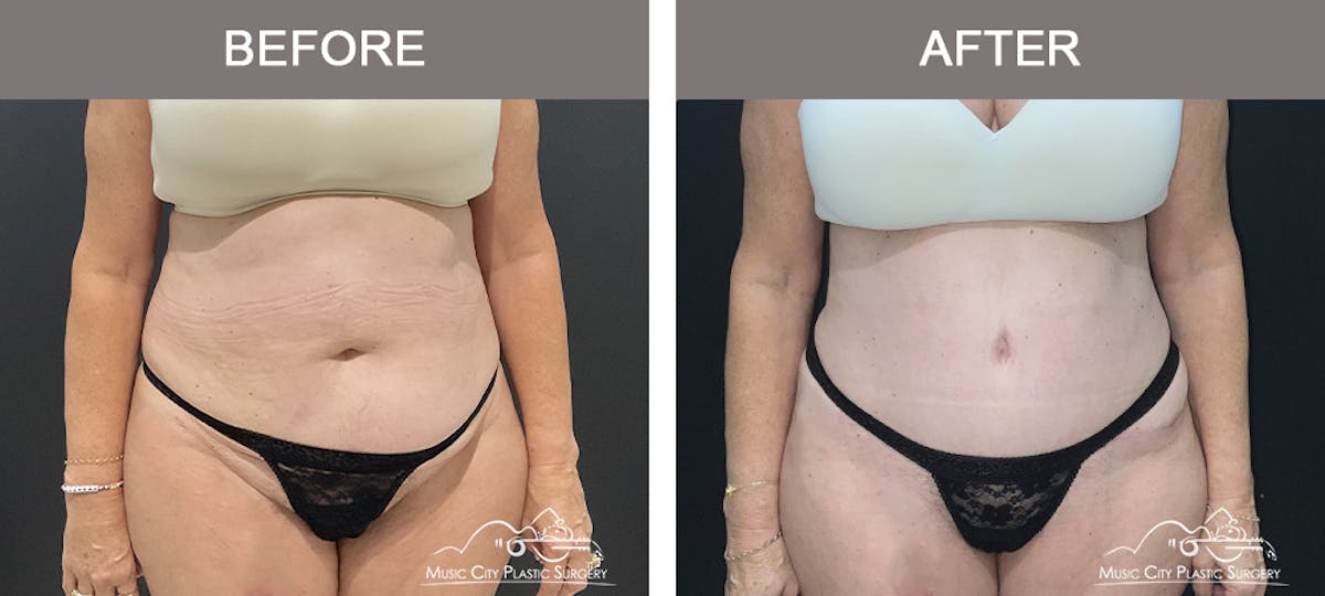 Tummy Tuck (Abdominoplasty) Before & After Gallery - Patient 310970 - Image 1