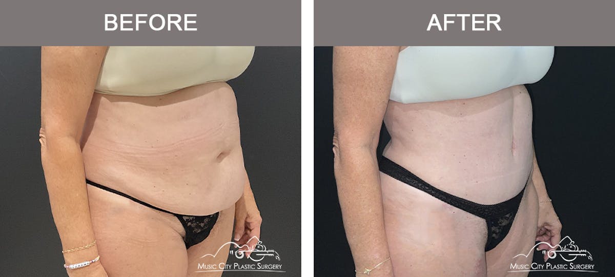 Tummy Tuck (Abdominoplasty) Before & After Gallery - Patient 310970 - Image 2
