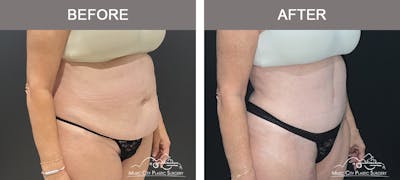 Tummy Tuck (Abdominoplasty) Before & After Gallery - Patient 310970 - Image 2