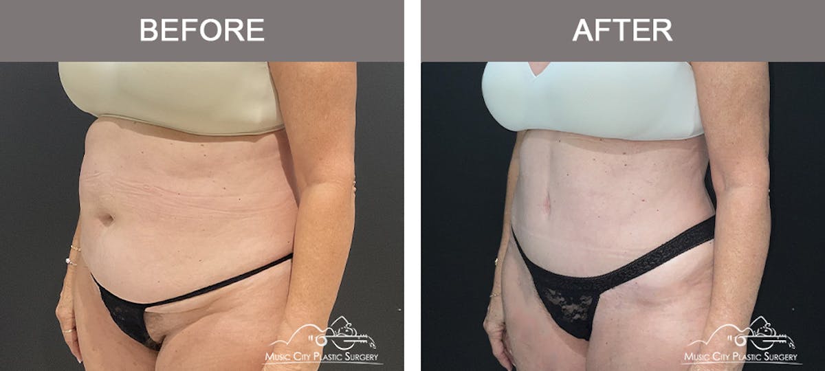 Tummy Tuck (Abdominoplasty) Before & After Gallery - Patient 310970 - Image 3