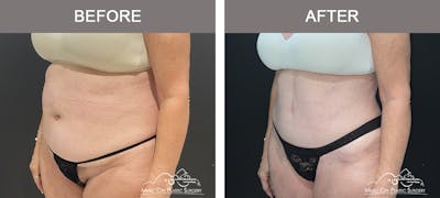 Tummy Tuck (Abdominoplasty) Before & After Gallery - Patient 310970 - Image 3