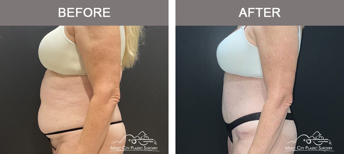 Tummy Tuck (Abdominoplasty) Before & After Gallery - Patient 310970 - Image 4