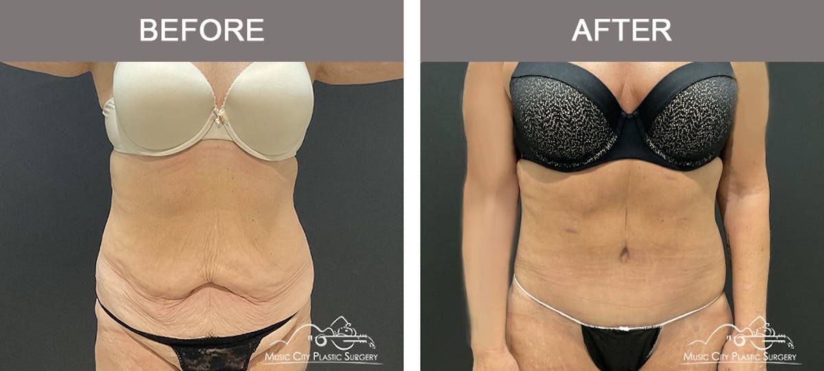 Belt Lipectomy Before & After Gallery - Patient 260950 - Image 1