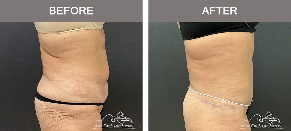 Belt Lipectomy Before & After Gallery - Patient 260950 - Image 2