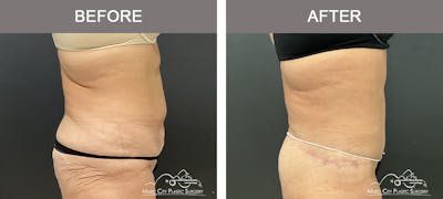 Belt Lipectomy Before & After Gallery - Patient 260950 - Image 2