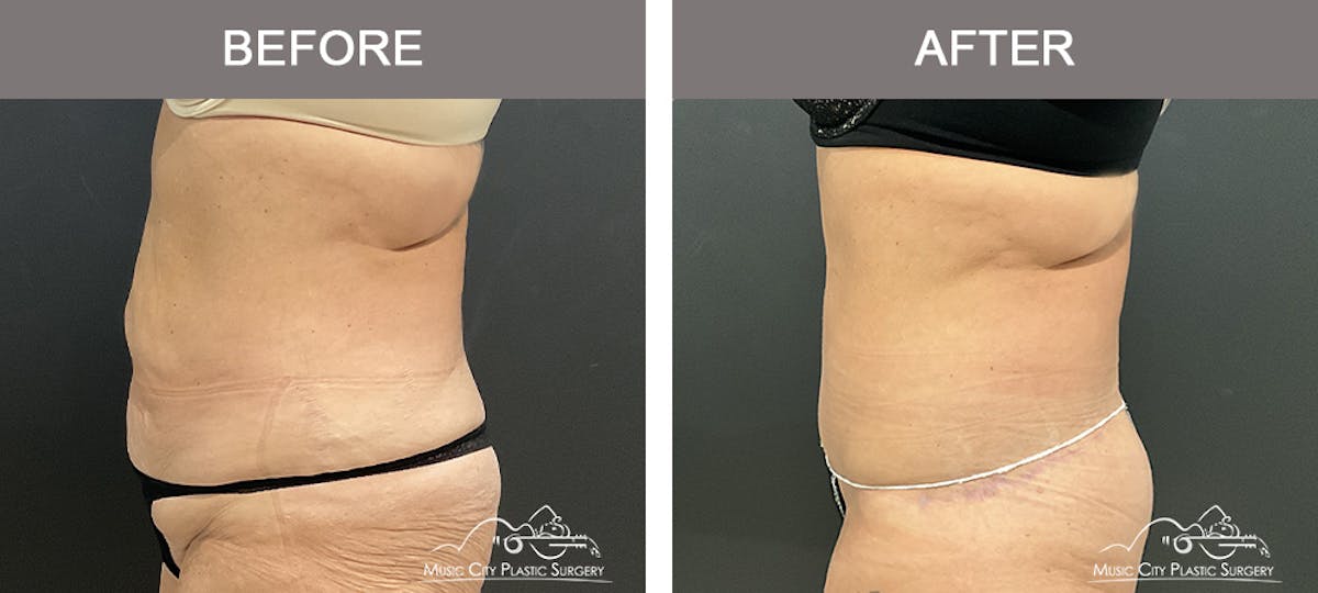 Belt Lipectomy Before & After Gallery - Patient 260950 - Image 3