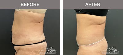 Belt Lipectomy Before & After Gallery - Patient 260950 - Image 3