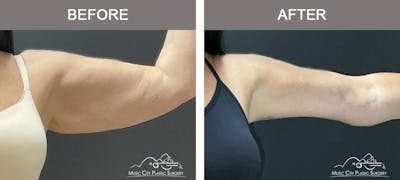 Arm Lift Before & After Gallery - Patient 123300 - Image 1