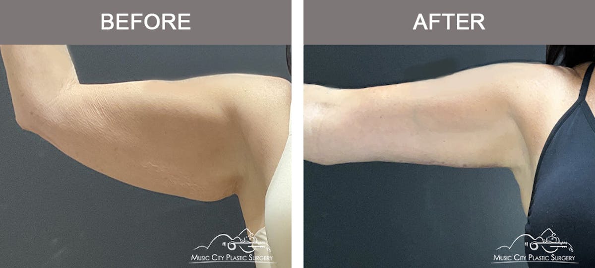 Arm Lift Before & After Gallery - Patient 123300 - Image 3