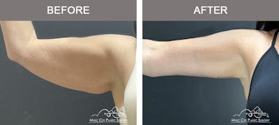 Arm Lift Before & After Gallery - Patient 123300 - Image 3