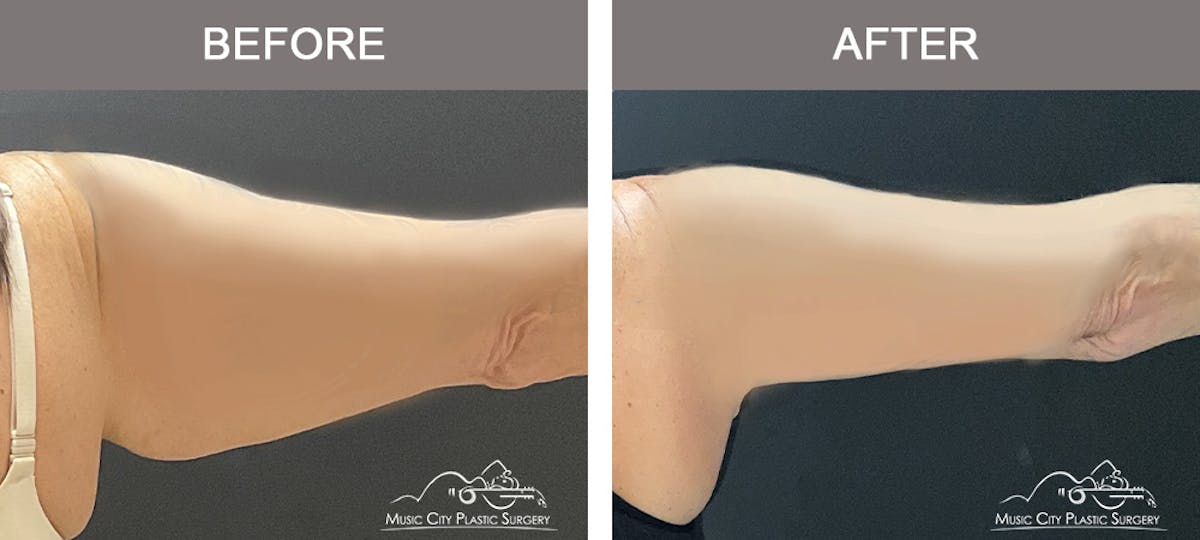 Arm Lift Before & After Gallery - Patient 123300 - Image 2