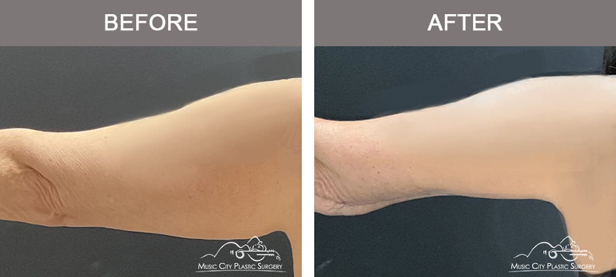 Arm Lift Before & After Gallery - Patient 123300 - Image 4