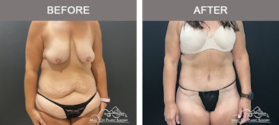 Belt Lipectomy Before & After Gallery - Patient 409941 - Image 1