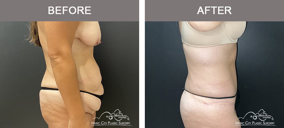 Belt Lipectomy Before & After Gallery - Patient 409941 - Image 2
