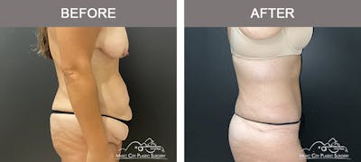 Belt Lipectomy Before & After Gallery - Patient 409941 - Image 2