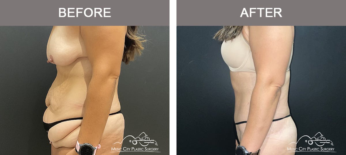 Belt Lipectomy Before & After Gallery - Patient 409941 - Image 3