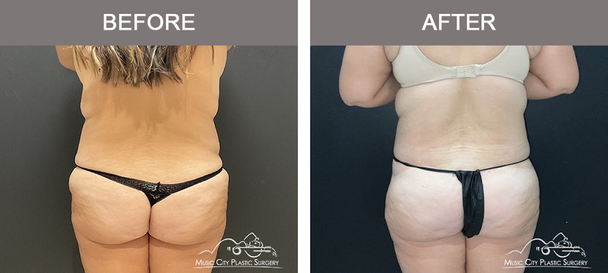 Belt Lipectomy Before & After Gallery - Patient 409941 - Image 4