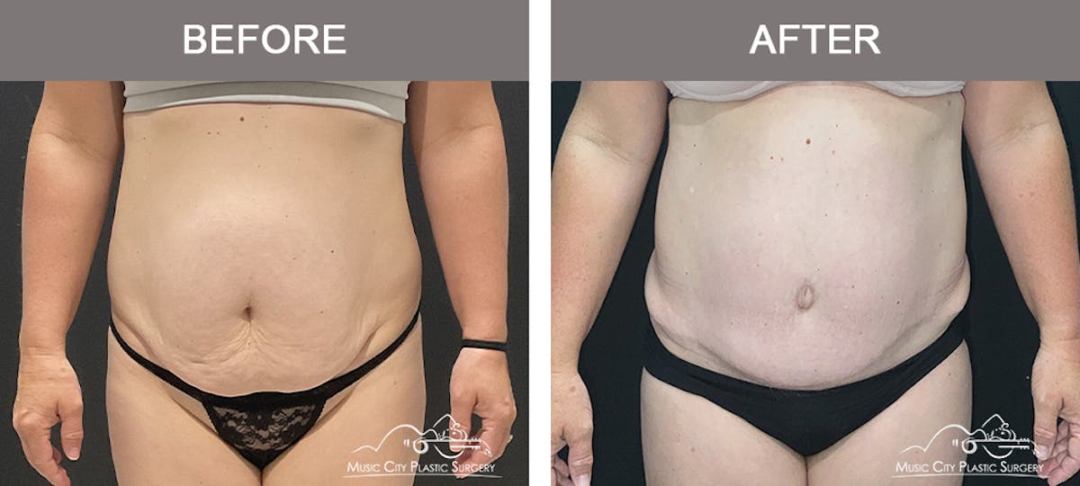 Liposuction Before & After Gallery - Patient 189126 - Image 1